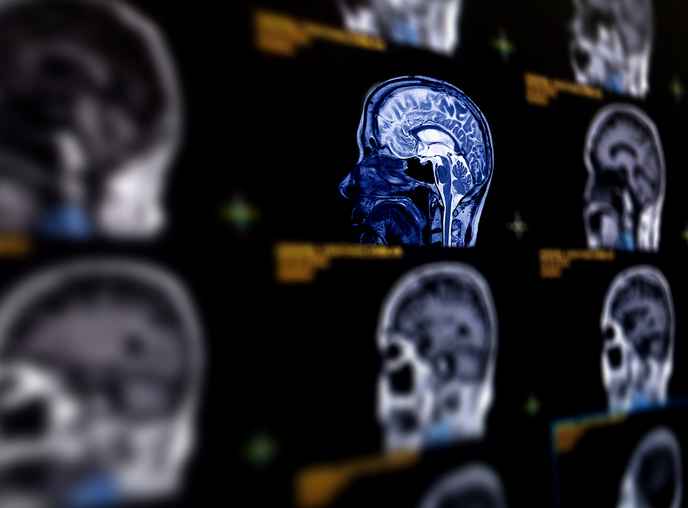 MRI scans showing traumatic brain injuries