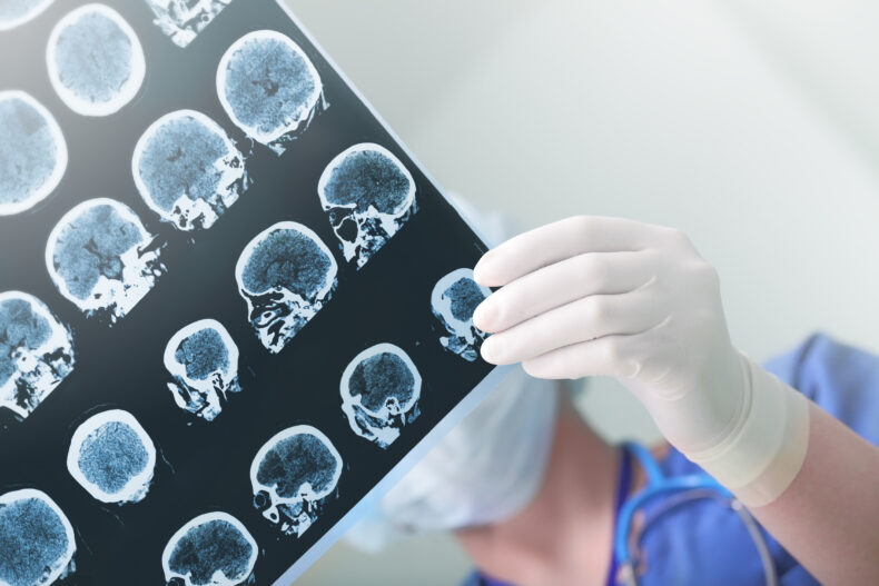 A brain injury is a common motorcycle injury.
