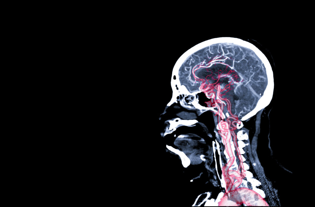 stages of recovery - Traumatic brain injuries